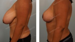 Thu nhỏ bộ ngực khổng lồ, nữ 31 tuổi - ca 12