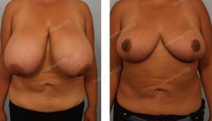 Thu nhỏ bộ ngực khổng lồ, nữ 31 tuổi - ca 12