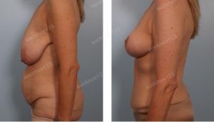 Combo treo sa trễ không đặt túi kết hợp tạo hình thành bụng, nữ 50 tuổi - ca 35