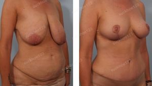 Combo treo sa trễ không đặt túi kết hợp tạo hình thành bụng, nữ 50 tuổi - ca 35