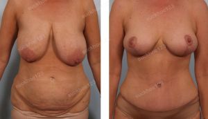 Combo treo sa trễ không đặt túi kết hợp tạo hình thành bụng, nữ 50 tuổi - ca 35