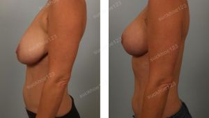 Thu nhỏ ngực, nữ 45 tuổi - ca 14