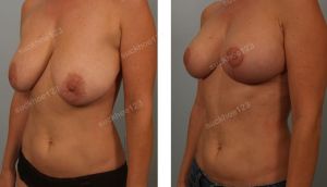 Thu nhỏ ngực, nữ 45 tuổi - ca 14