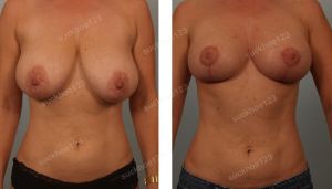 Thu nhỏ ngực, nữ 45 tuổi - ca 14