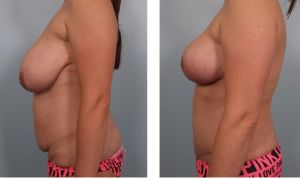 Thu nhỏ ngực phì đại kết hợp tạo hình thành bụng, nữ 37 tuổi - ca 15