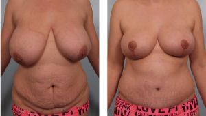 Thu nhỏ ngực phì đại kết hợp tạo hình thành bụng, nữ 37 tuổi - ca 15