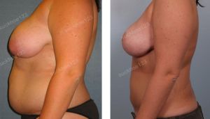 Thu nhỏ ngực phì đại kết hợp hút mỡ nhiều vùng, nữ 26 tuổi - ca 17