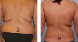 Thu nhỏ ngực phì đại kết hợp hút mỡ nhiều vùng, nữ 26 tuổi - ca 17