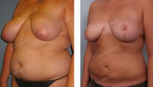 Thu nhỏ ngực phì đại kết hợp hút mỡ nhiều vùng, nữ 26 tuổi - ca 17