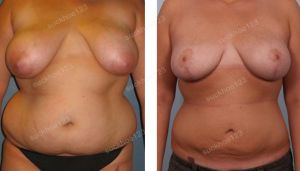 Thu nhỏ ngực phì đại kết hợp hút mỡ nhiều vùng, nữ 26 tuổi - ca 17