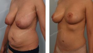 Thu nhỏ ngực phì đại kết hợp tạo hình thành bụng và hút mỡ ụ hông, nữ 34 tuổi - ca 2