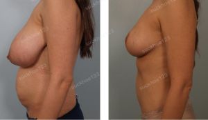 Thu nhỏ ngực phì đại kết hợp tạo hình thành bụng và hút mỡ ụ hông, nữ 34 tuổi - ca 2