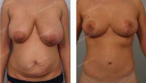 Thu nhỏ ngực phì đại kết hợp tạo hình thành bụng và hút mỡ ụ hông, nữ 34 tuổi - ca 2