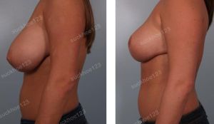 Thu nhỏ ngực phì đại, nữ 23 tuổi - ca 5