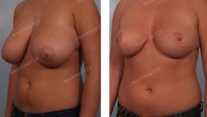 Thu nhỏ ngực phì đại, nữ 23 tuổi - ca 5