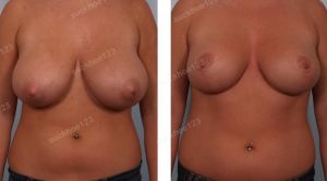 Thu nhỏ ngực phì đại, nữ 23 tuổi - ca 5