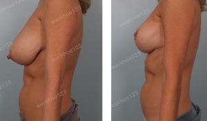 Thu nhỏ ngực phì đại, nữ 40 tuổi - ca 6