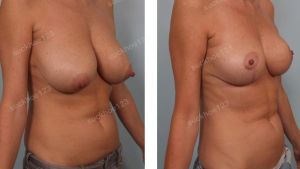 Thu nhỏ ngực phì đại, nữ 40 tuổi - ca 6