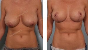 Thu nhỏ ngực phì đại, nữ 40 tuổi - ca 6