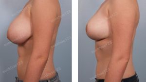 Thu nhỏ ngực phì đại, nữ 17 tuổi - ca 7