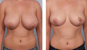 Thu nhỏ ngực phì đại, nữ 17 tuổi - ca 7