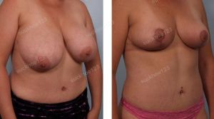 Thu nhỏ ngực bự lệch 2 bên, nữ 34 tuổi - ca 9