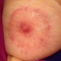 8 tháng sau treo ngực sa trễ mà vẫn lộ sẹo