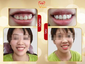 Hình ảnh điều trị cười hở lợi – Nha khoa Quốc tế Vip Dentist - Ca 1