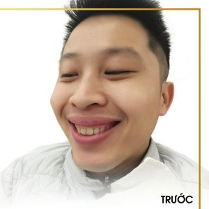 Hình ảnh điều trị cười hở lợi – Nha khoa Quốc tế Vip Dentist - Ca 10