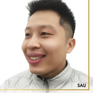 Hình ảnh điều trị cười hở lợi – Nha khoa Quốc tế Vip Dentist - Ca 10