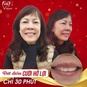 Hình ảnh điều trị cười hở lợi – Nha khoa Quốc tế Vip Dentist - Ca 11