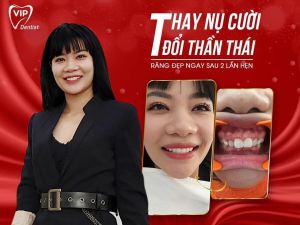 Hình ảnh bọc răng sứ - Nha khoa Quốc tế Vip Dentist - Ca 12