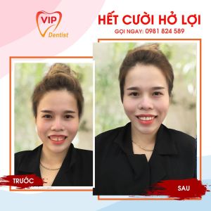 Hình ảnh điều trị cười hở lợi – Nha khoa Quốc tế Vip Dentist - Ca 13