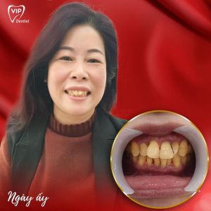 Hình ảnh bọc răng sứ - Nha khoa Quốc tế Vip Dentist - Ca 14