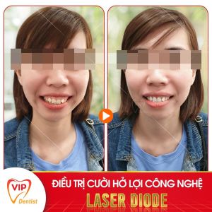 Hình ảnh điều trị cười hở lợi – Nha khoa Quốc tế Vip Dentist  - Ca 15