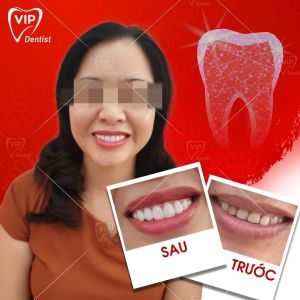 Hình ảnh điều trị cười hở lợi – Nha khoa Quốc tế Vip Dentist  - Ca 16
