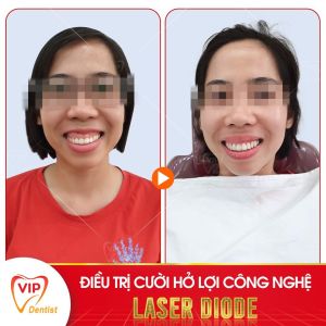 Hình ảnh điều trị cười hở lợi – Nha khoa Quốc tế Vip Dentist  - Ca 17