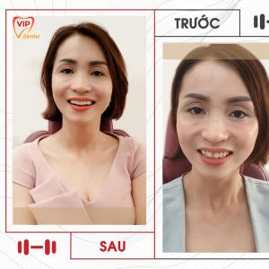 Hình ảnh bọc răng sứ - Nha khoa Quốc tế Vip Dentist - Ca 18