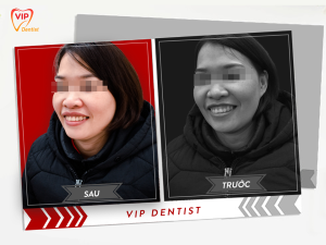 Hình ảnh điều trị cười hở lợi – Nha khoa Quốc tế Vip Dentist - Ca 19
