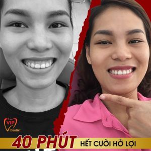 Hình ảnh điều trị cười hở lợi – Nha khoa Quốc tế Vip Dentist  - Ca 21