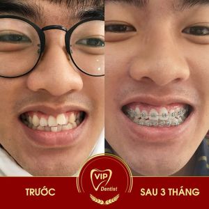 Hình ảnh niềng răng mắc cài – Nha khoa Quốc tế Vip Dentist – Ca 22