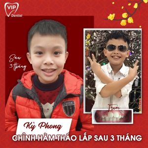 Hình ảnh chỉnh nha cho bé Kỳ Phong – Nha khoa Quốc tế Vip Dentist - Ca 23