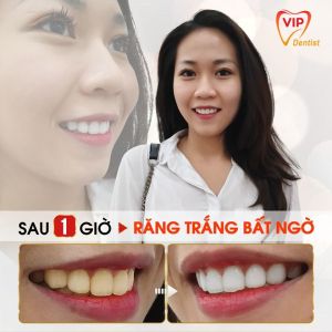 Hình ảnh tẩy trắng răng – Nha khoa Quốc tế Vip Dentist - Ca 5