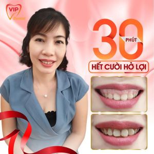 Hình ảnh điều trị cười hở lợi – Nha khoa Quốc tế Vip Dentist - Ca 6
