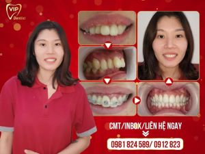 Hình ảnh niềng răng mắc cài – Nha khoa Quốc tế Vip Dentist - Ca 7