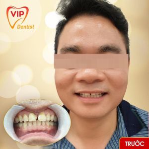 Hình ảnh bọc răng sứ - Nha khoa Quốc tế Vip Dentist - Ca 8