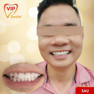 Hình ảnh bọc răng sứ - Nha khoa Quốc tế Vip Dentist - Ca 8