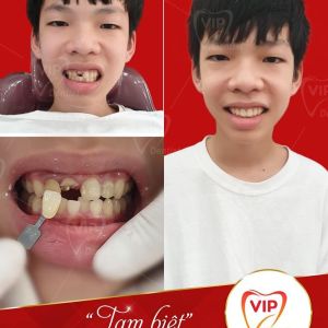 Hình ảnh bọc răng sứ - Nha khoa Quốc tế Vip Dentist - Ca 9