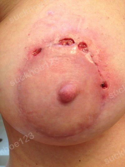 Sửa sẹo sau treo ngực sa trễ nhưng vết khâu bị hở sau 5 ngày, có phải là nhiễm trùng?