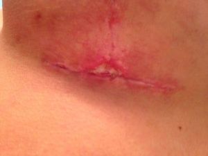 Vết mổ hình chữ T ngược lâu liền sau khi treo ngực sa trễ được 4 tuần?